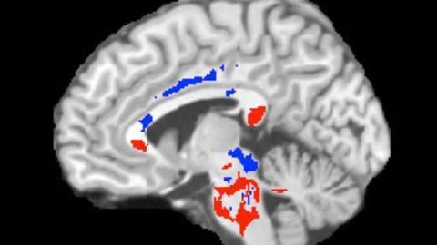 Concussion outcome predicted using advanced imaging