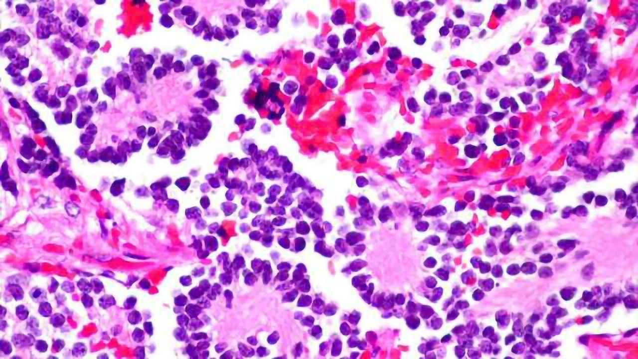 Doctors unleash new weapon to fight pediatric neuroblastoma