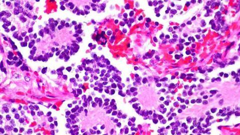 Doctors unleash new weapon to fight pediatric neuroblastoma