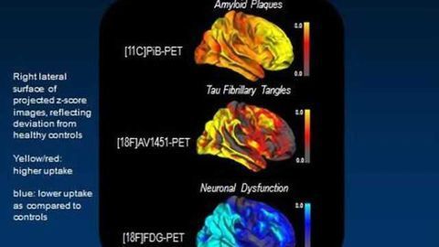 PET points to tau protein as leading culprit in Alzheimer's