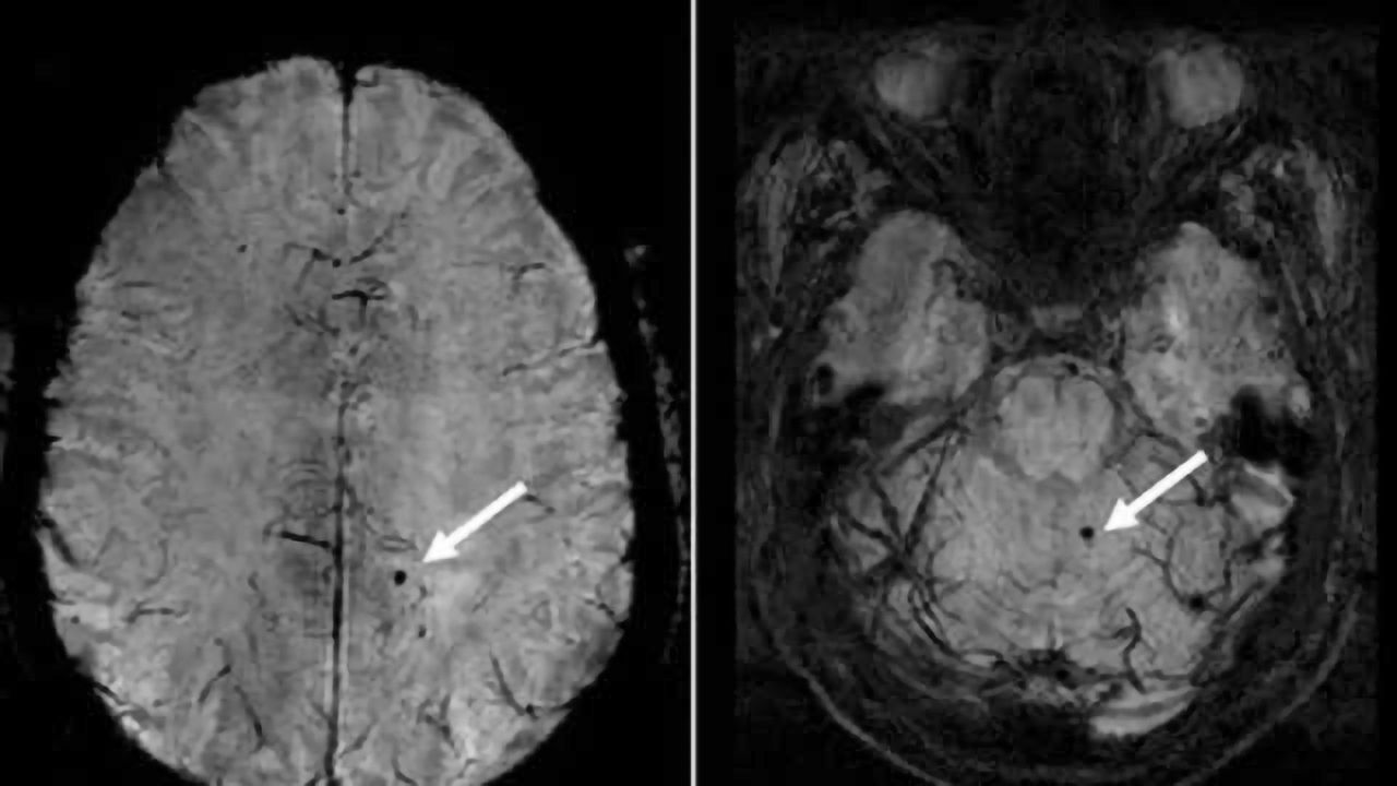 Cerebral microbleeds in MS are associated with increased risk for disability