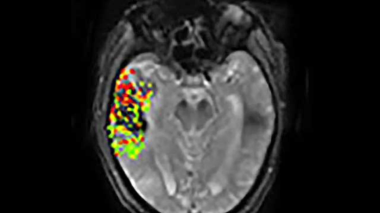 New imaging method may predict risk of post-treatment brain bleeding after stroke