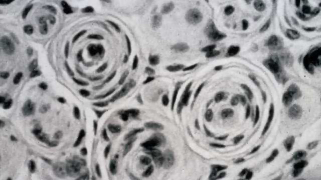 High blood sugar could mean lower risk of one type of brain tumor