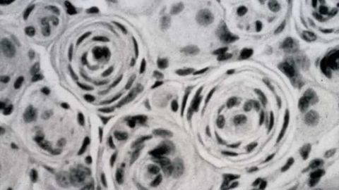 High blood sugar could mean lower risk of one type of brain tumor