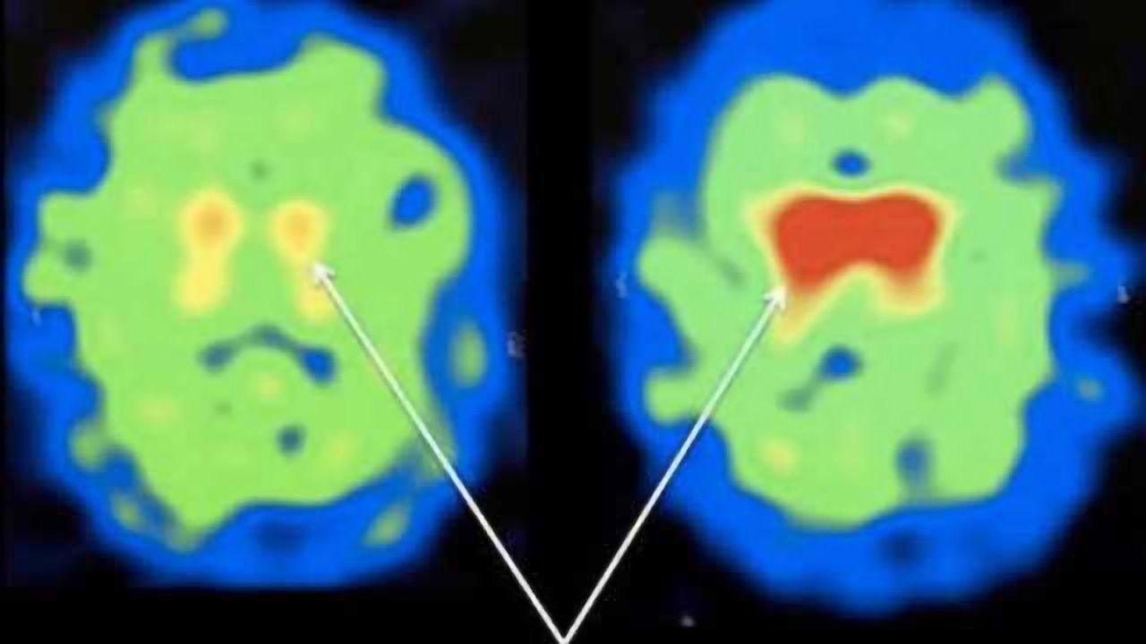 Antioxidant molecule could improve Parkinson's