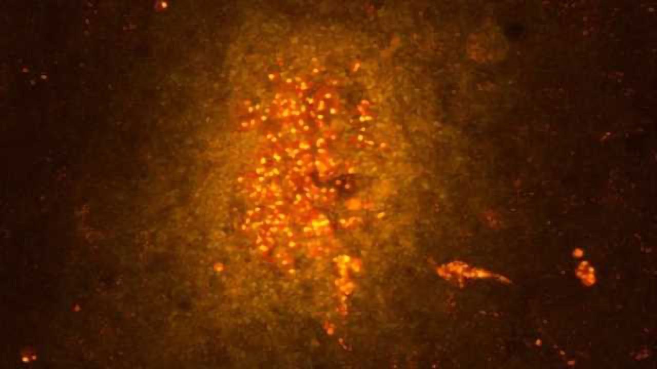 Can anti-inflammatory therapies be effective against epilepsy?
