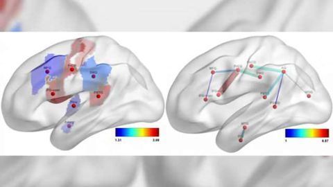 Predicting language deficits after stroke with connectome-based imaging
