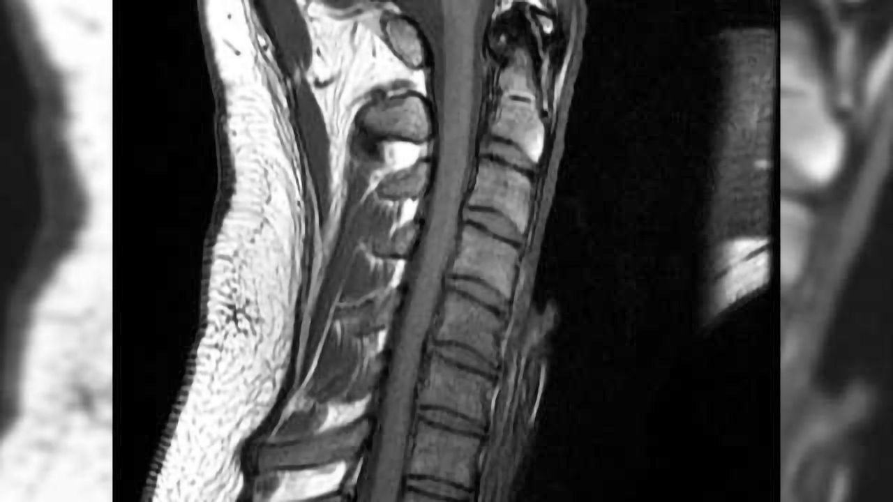 Spinal cord stimulation is a safe, effective drug-free treatment for chronic pain