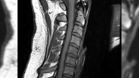 Spinal cord stimulation is a safe, effective drug-free treatment for chronic pain