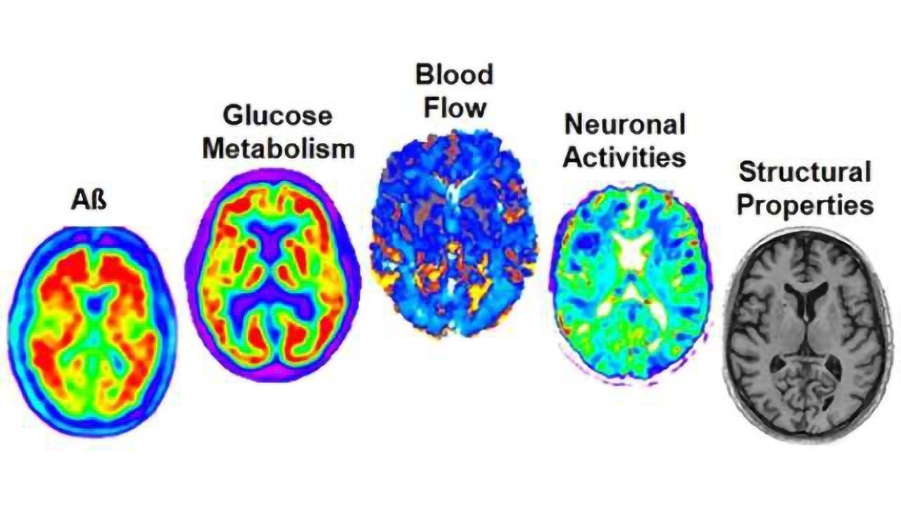 'Big Data' study discovers earliest sign of Alzheimer's development