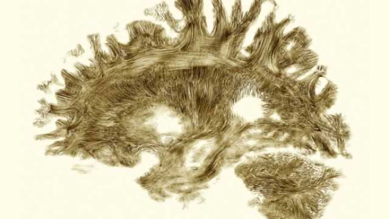 More evidence that male and female brains are wired differently