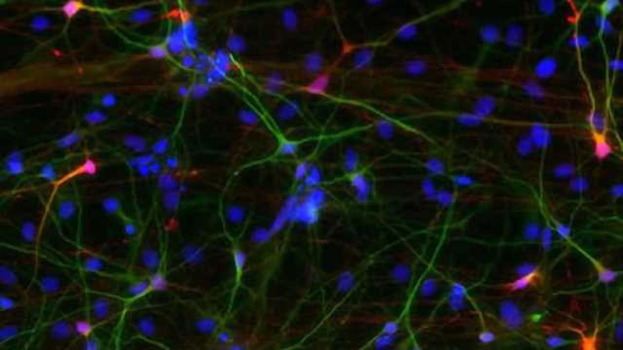 Mini-brain model of idiopathic autism reveals underlying pathology of neuronal overgrowth
