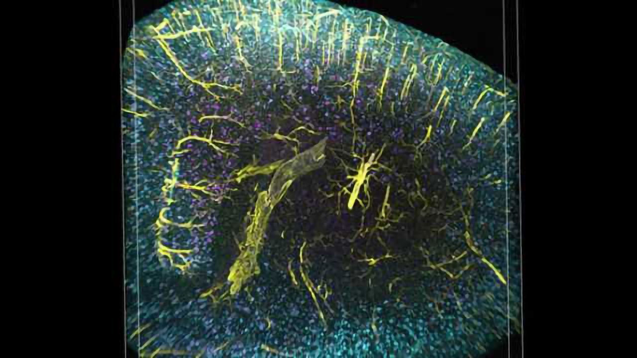 3-D imaging reveals unexpected arrangement of plaques in Alzheimer's-afflicted brains