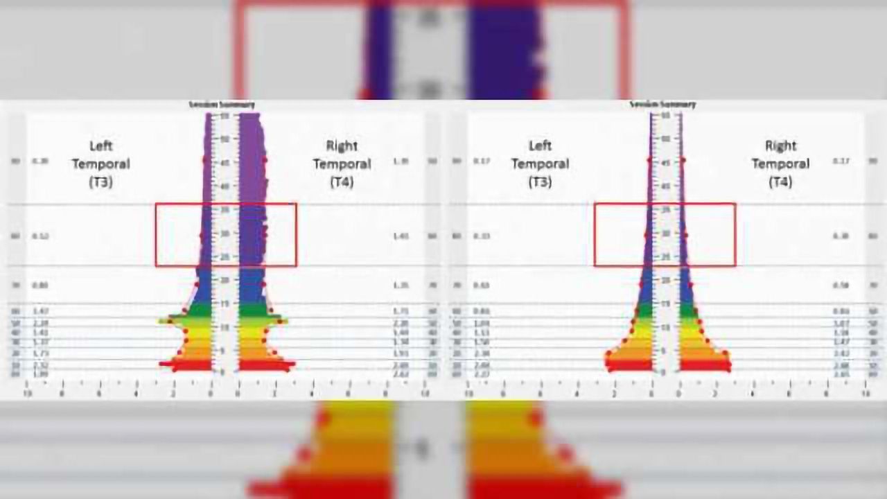 Athletes with concussion maintain improvements after use of mirroring neurotechnology