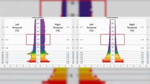 Athletes with concussion maintain improvements after use of mirroring neurotechnology