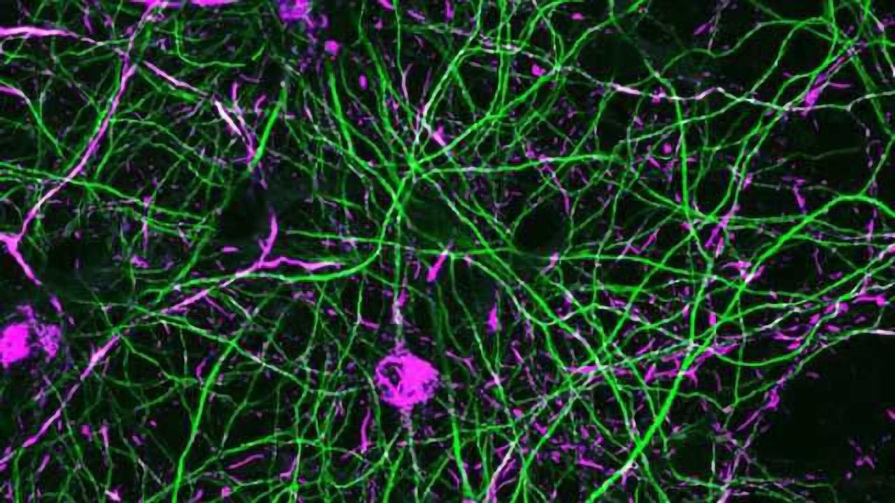Discovery may lead to a treatment to slow Parkinson's disease