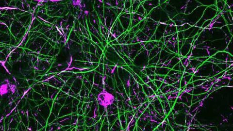 Discovery may lead to a treatment to slow Parkinson's disease