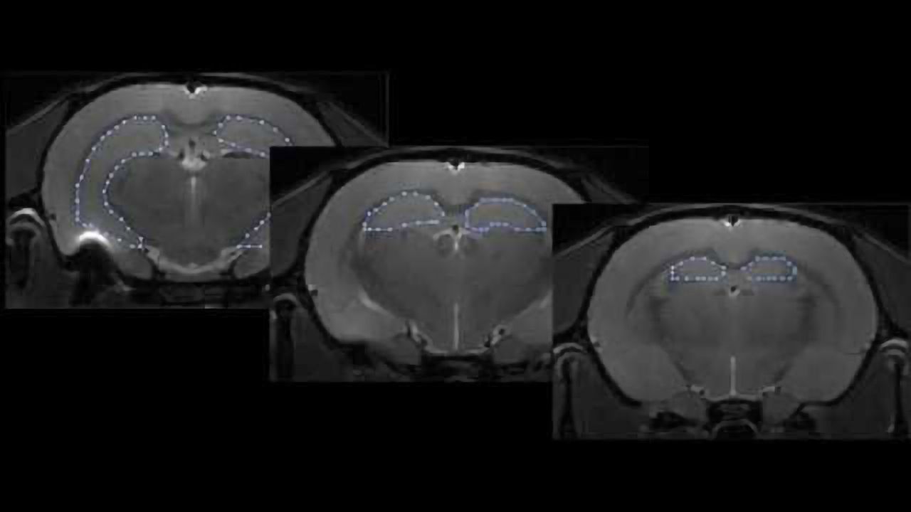 Can a brain scan early in stress predict eventual memory loss?