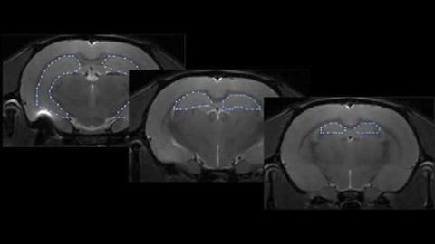 Can a brain scan early in stress predict eventual memory loss?