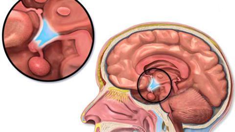 Small clinical study successfully treats rare form of obesity