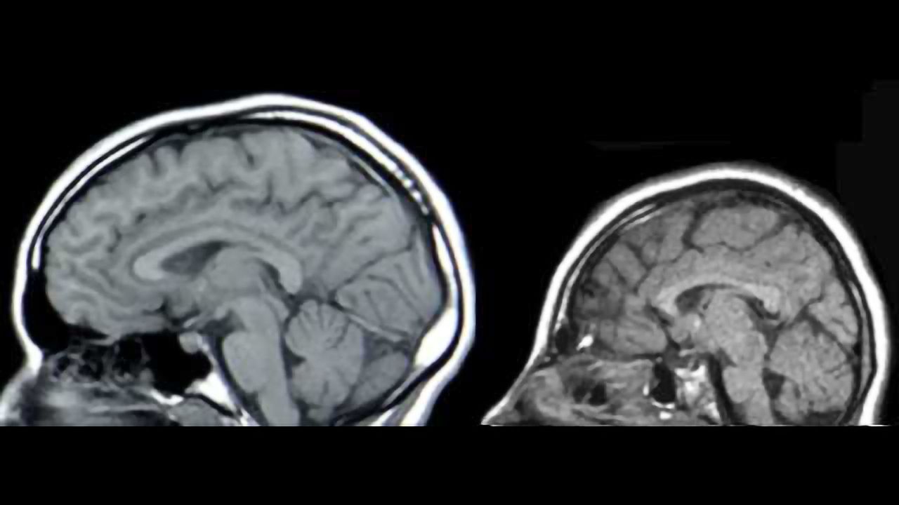 Microcephaly discoveries made in non-Zika cases help explain abnormal brain growth