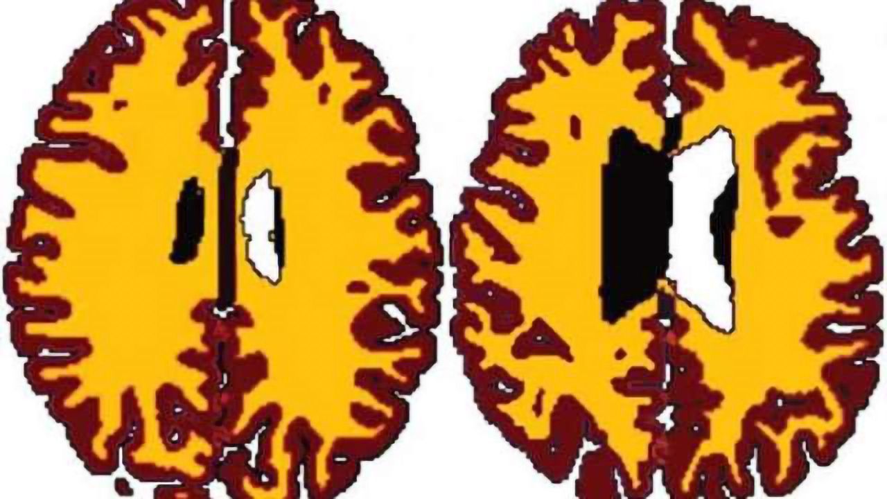 Brains of overweight people 'ten years older' than lean counterparts at middle-age