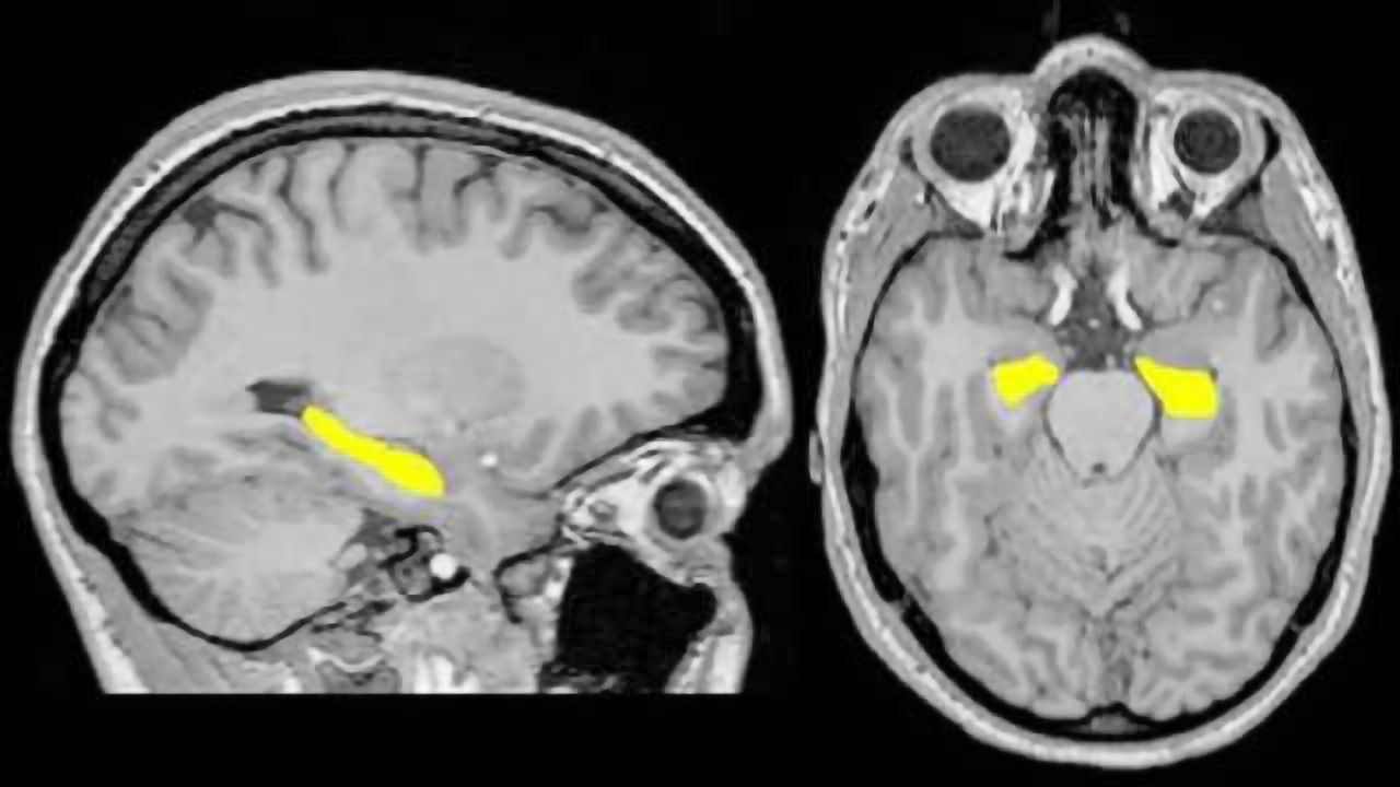 In search of neurobiological factors for schizophrenia