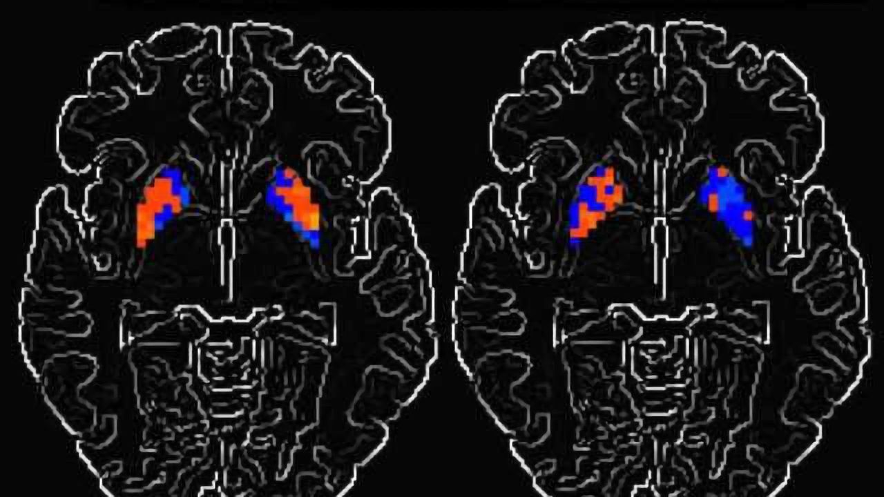 How Parkinson's disease alters brain activity over time