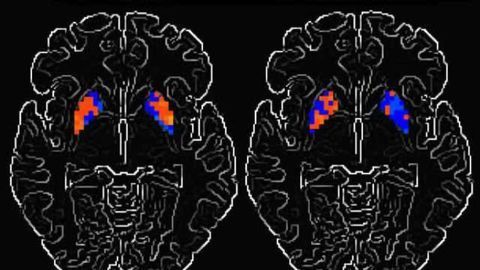 How Parkinson's disease alters brain activity over time