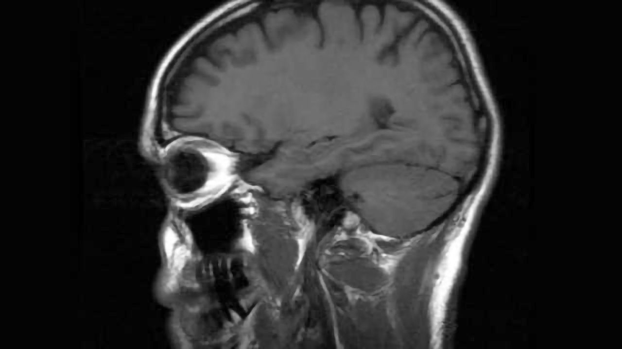 Curbing the life-long effects of traumatic brain injury