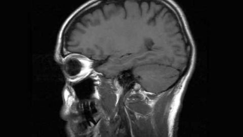 Curbing the life-long effects of traumatic brain injury