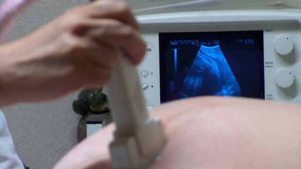 Study examines use of antipsychotics early in pregnancy, risk of birth defects