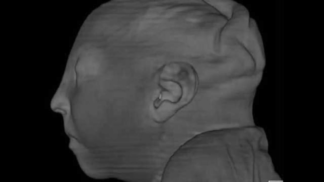 New report details pre- and postnatal brain defects from Zika virus