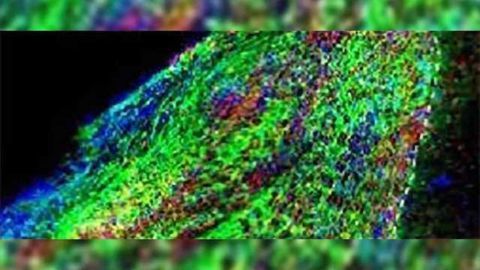 Stem cell therapy heals injured mouse brain