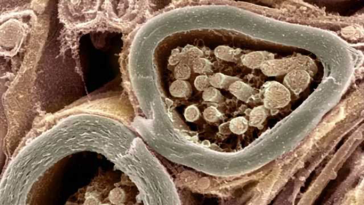 Scientists identify spark plug that ignites nerve cell demise in ALS