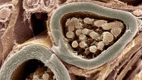 Scientists identify spark plug that ignites nerve cell demise in ALS