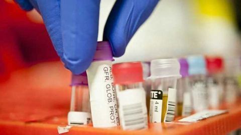 Major step towards Alzheimer's blood test