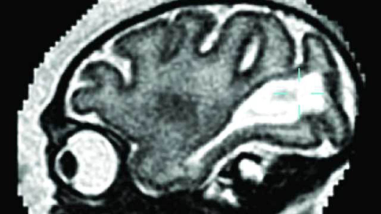 Study details how Zika damages fetal brain