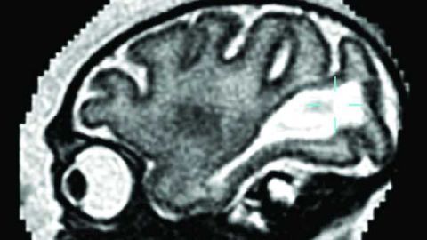 Study details how Zika damages fetal brain