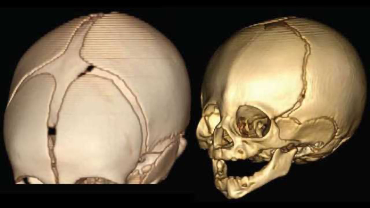Rare and common genetic variants combine to cause skull-fusion disorder