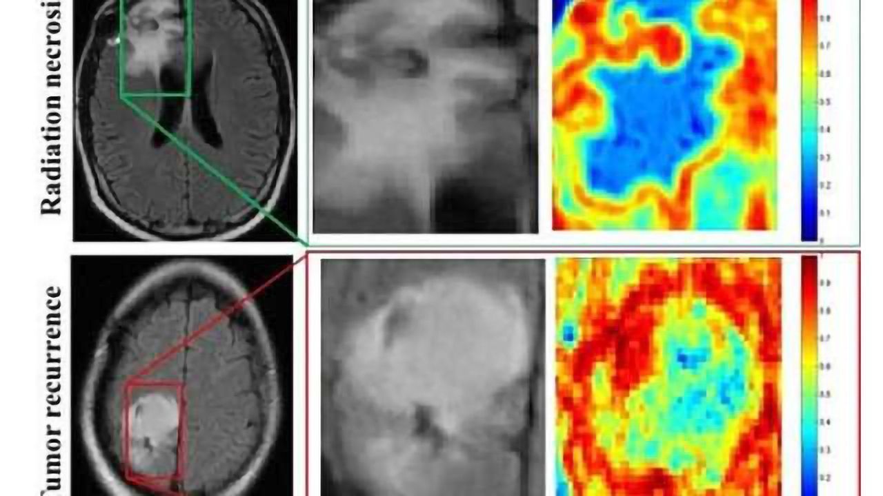 Computer program beats physicians at brain cancer diagnoses