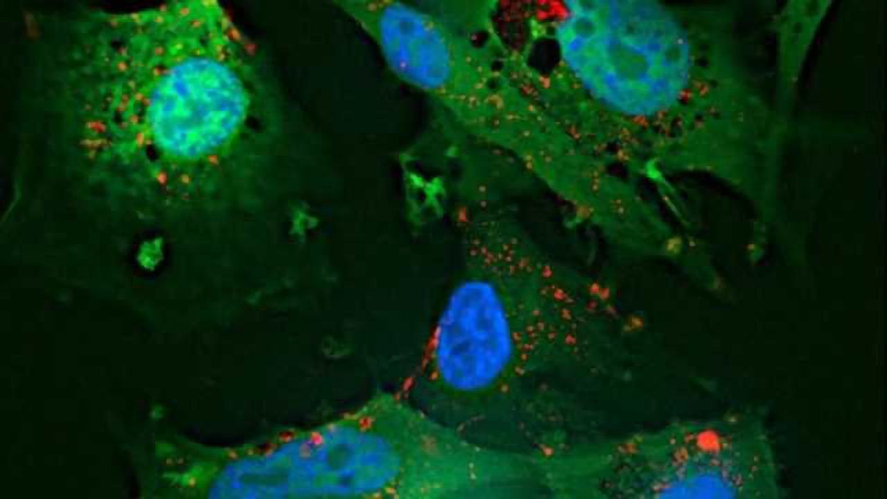 New hope in fight against aggressive, often hard to treat brain tumor
