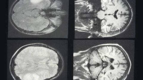 Immune and targeted therapies with radiation therapy improves outcomes for melanoma brain metastases patients, say researchers