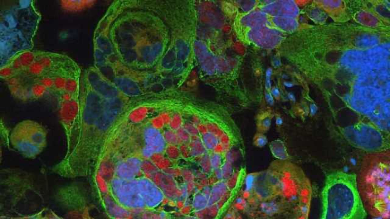 Custom-tailored strategy against glioblastomas