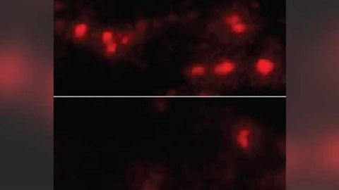 New treatment strategy could cut Parkinson's disease off at the pass