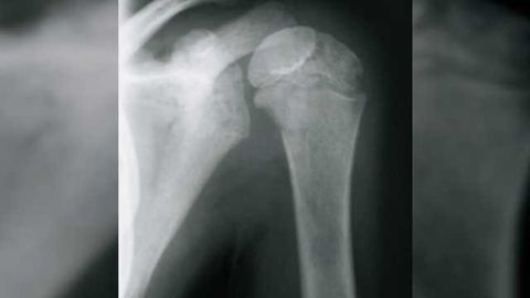 Nuclear protein causes neuroblastoma to become more aggressive