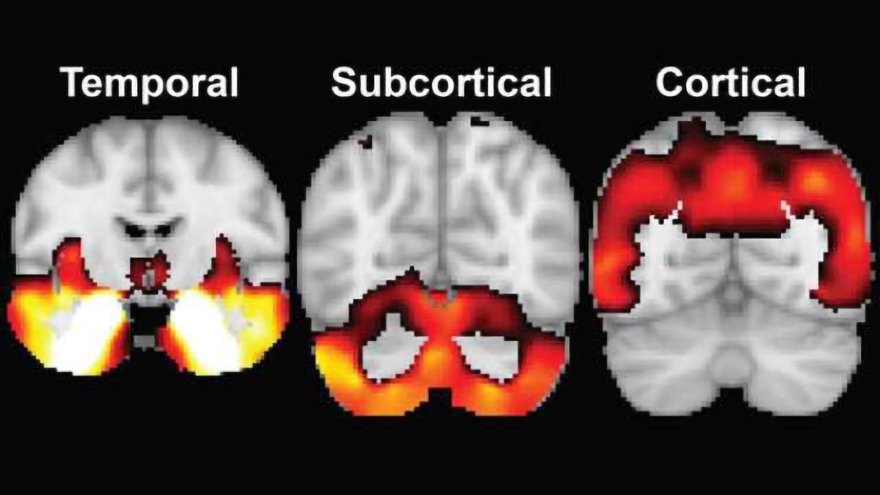 Different brain atrophy patterns may explain variability in Alzheimers disease symptoms