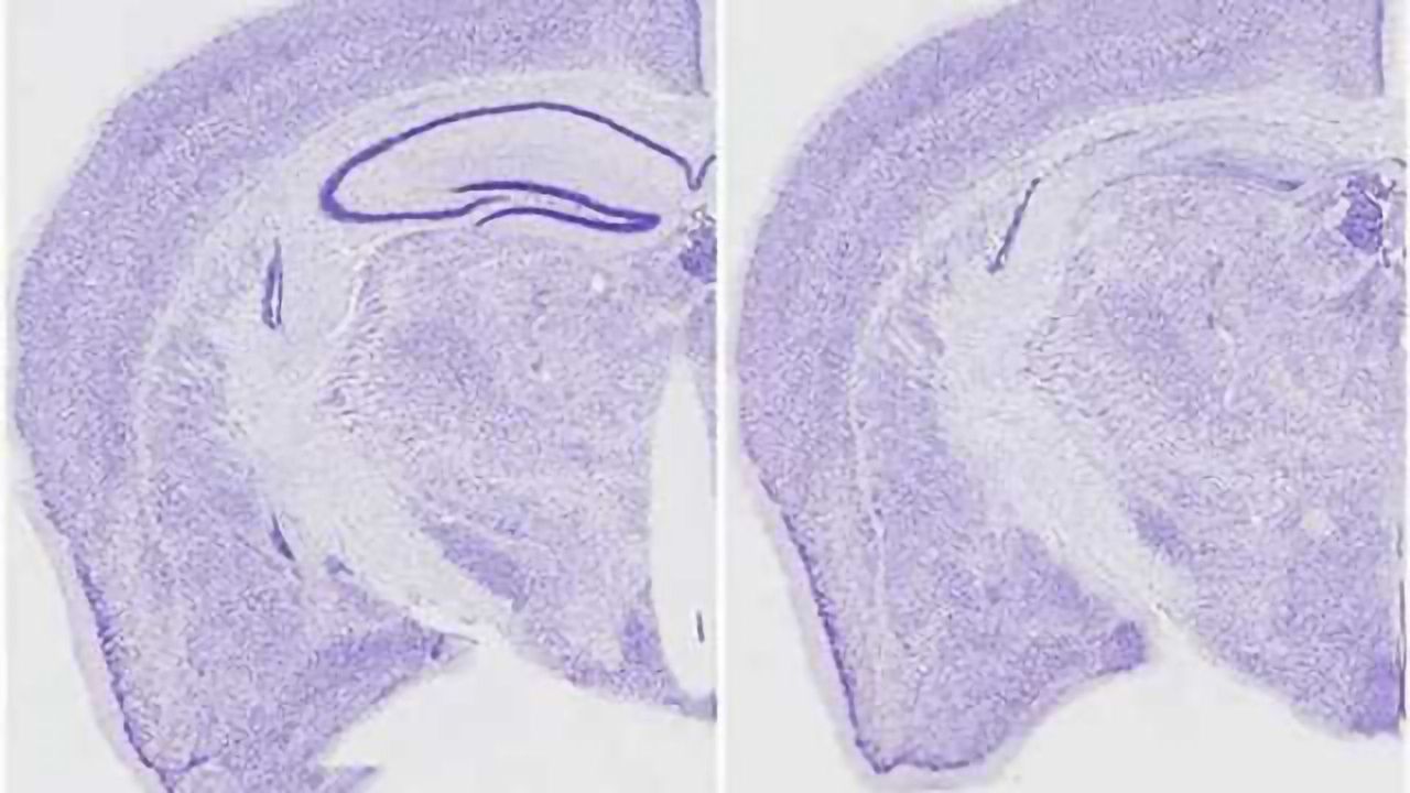 Untangling a cause of memory loss in neurodegenerative diseases
