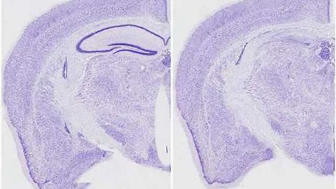 Untangling a cause of memory loss in neurodegenerative diseases