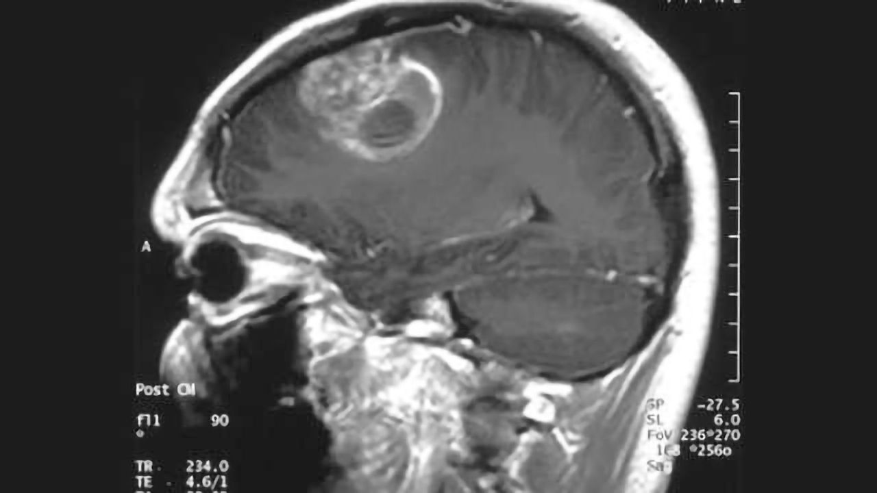 Depriving deadly brain tumors of cholesterol may be their Achilles' heel